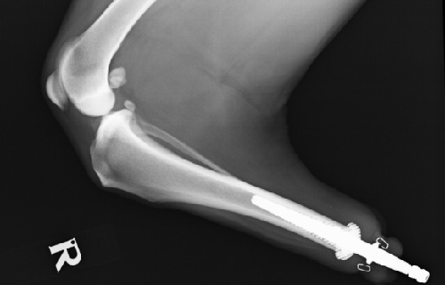 Radiograph showing custom-made prosthesis