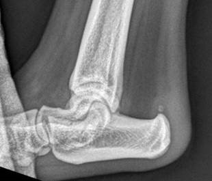 Radiograph demonstrating the presence of calcific deposits within the Achilles tendon of a dog presenting with Achilles tendon degeneration