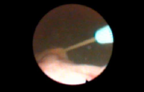 Cystoscopic image of ureteral catheter being placed